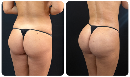 Gluteoplastía
