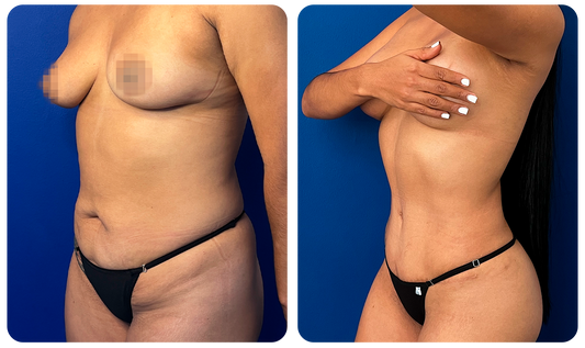 Abdominoplastía
